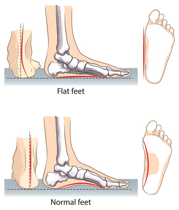 Flat Feet calgary Treatment Alberta