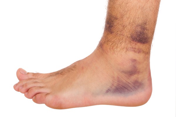 Foot and Ankle Injuries calgary, Alberta