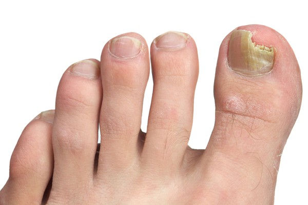 The Truth About Thickened Toenails - Sutherland Podiatry