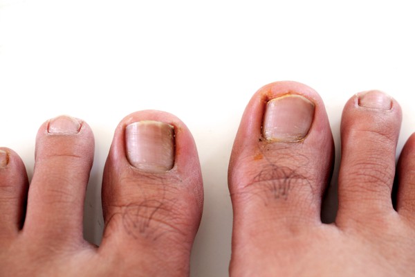 Ingrown Toenail calgary, Alberta