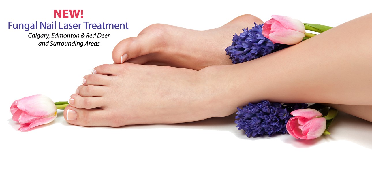 Fungal Nail Laser Calgary